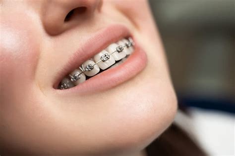 metal orthodontic bracket|different types of metal brackets.